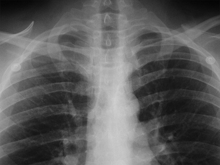 Chest x-ray